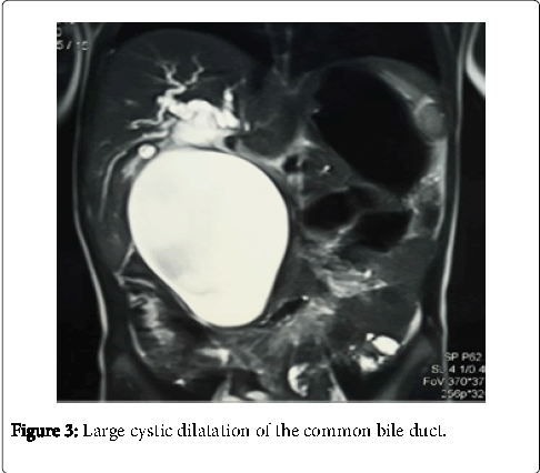 neonatal-and-pediatric-medicine-large-cystic-dilatation