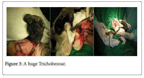 neonatal-and-pediatric-medicine-trichobezoar