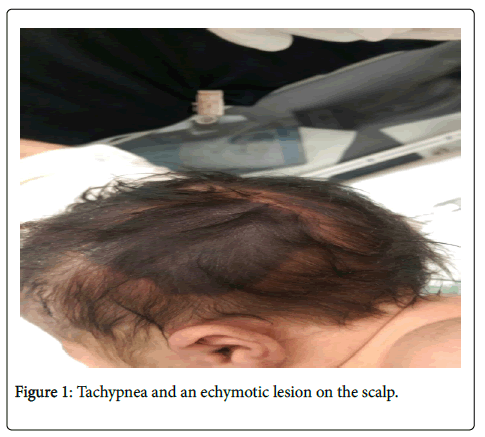 neonatal-pediatric-medicine-echymotic