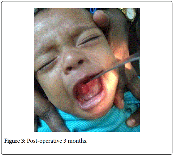 neonatal-pediatric-medicine-post-operative-months
