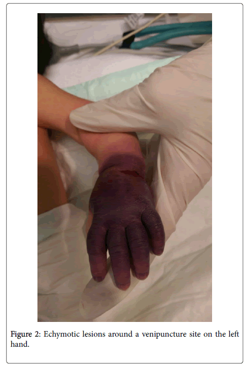 neonatal-pediatric-medicine-venipuncture