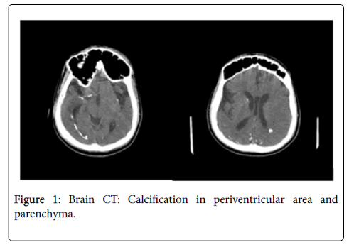 neuroinfectious-diseases-Calcification-periventricular