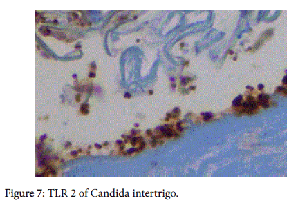 Candida-intertrigo