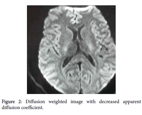 neuroinfectious-diseases-Diffusion-weighted