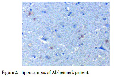 Hippocampus-Alzheimers-patient