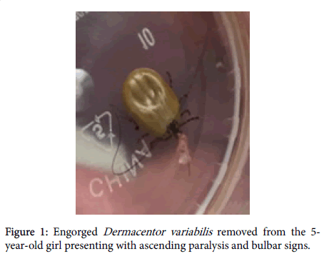 neuroinfectious-diseases-ascending-paralysis-bulbar