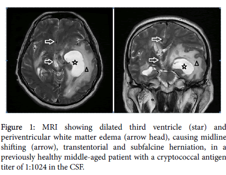 neuroinfectious-diseases-dilated-third-ventricle