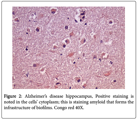 neuroinfectious-diseases-disease-hippocampus