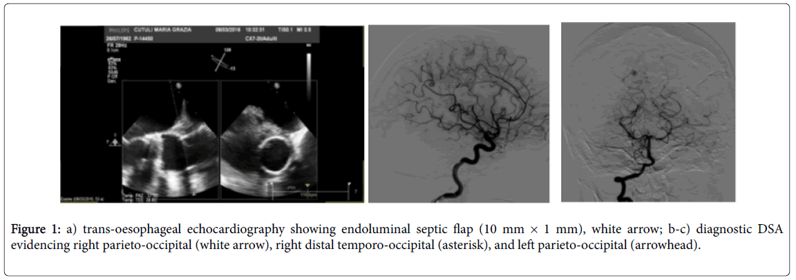 neuroinfectious-diseases-echocardiography