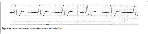 neuroinfectious-diseases-idioventricular-rhythm