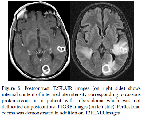 intermediate-intensity-tuberculoma