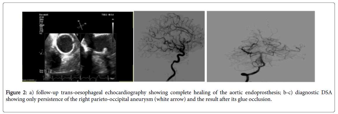 neuroinfectious-diseases-trans-oesophageal