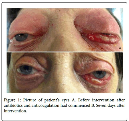 cavernous sinus thrombosis