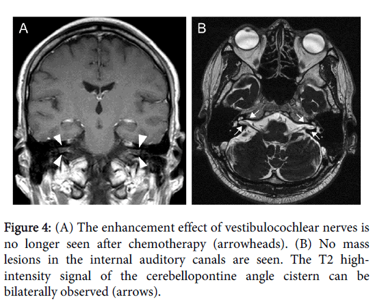 internal auditory canal mri sample dictation internal auditory canal mri sample dictation
