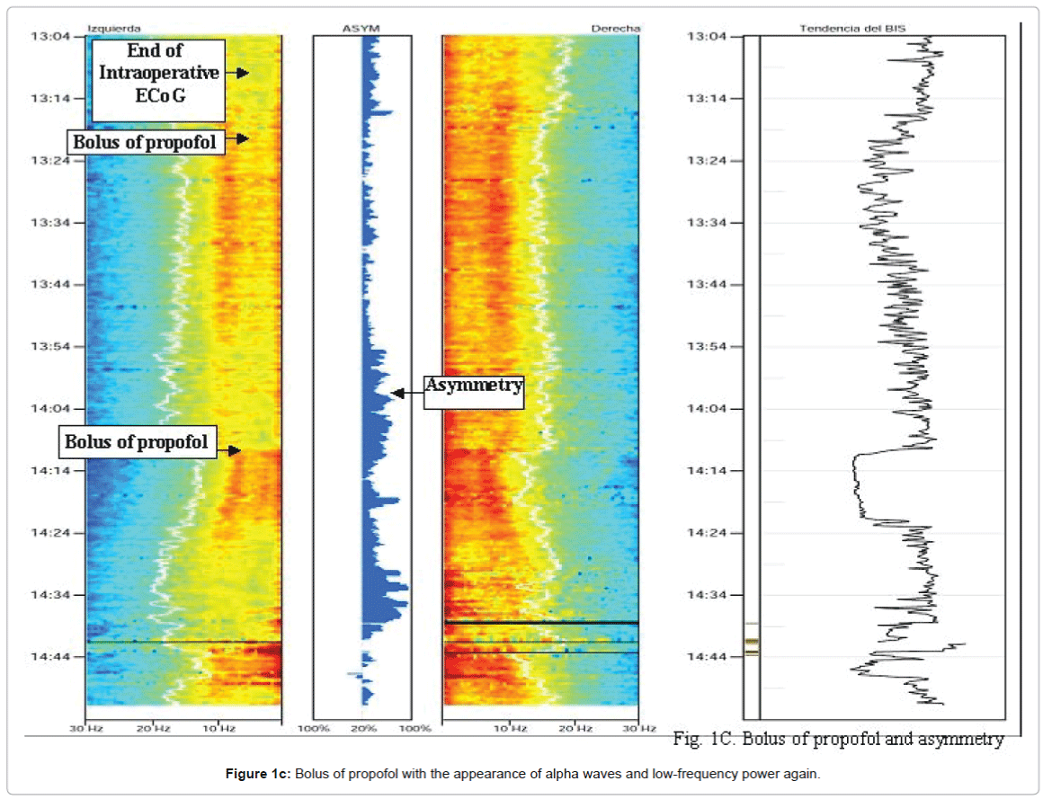 Changes in Density Spectral Array of BIS VISTA Monitoring System in ...