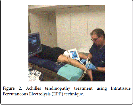 novel-physiotherapies-Achilles-tendinopathy