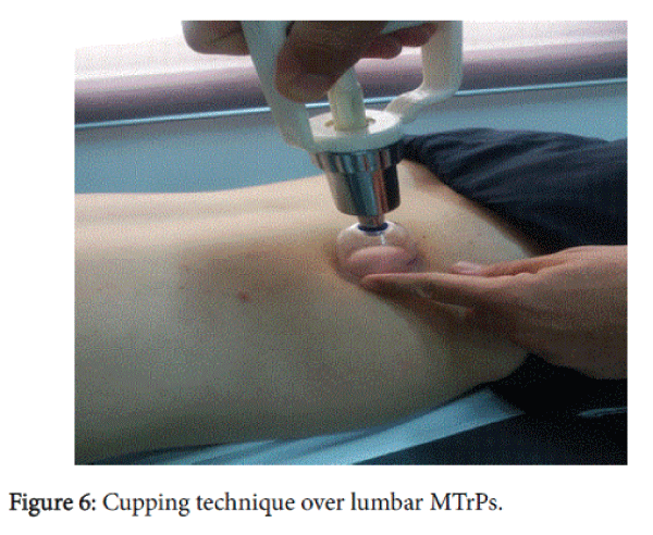 novel-physiotherapies-Cupping-technique