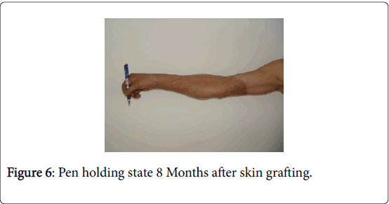 novel-physiotherapies-Pen-holding