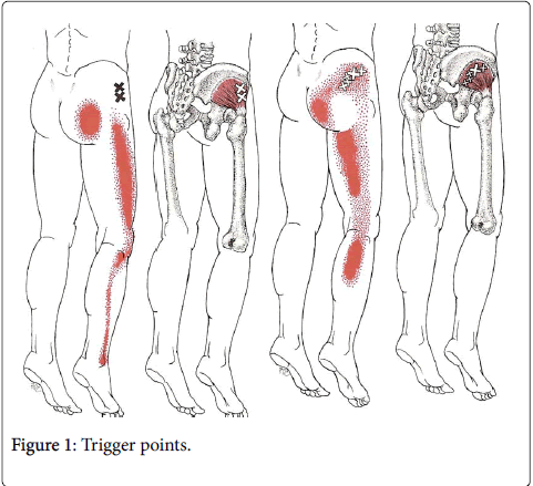novel-physiotherapies-Trigger-points