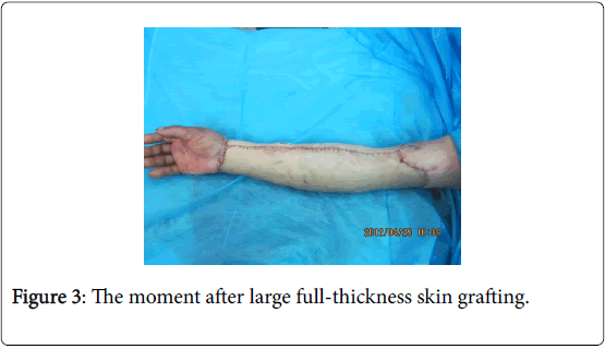 novel-physiotherapies-full-thickness