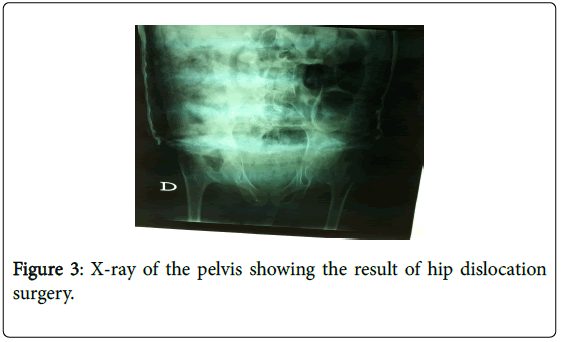 novel-physiotherapies-hip-dislocation