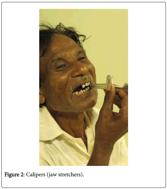 novel-physiotherapies-jaw-stretchers
