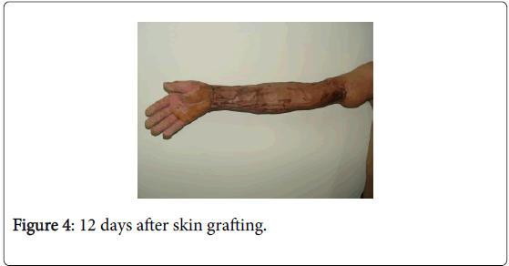 novel-physiotherapies-skin-grafting