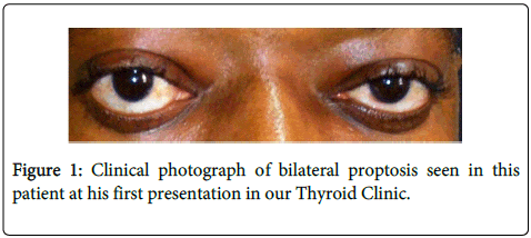 proptosis as first presentation of graves disease omics international proptosis