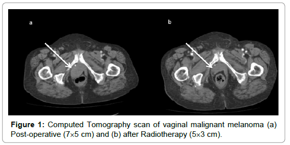 vaginal malignant melanoma Asian spa fees cost services
