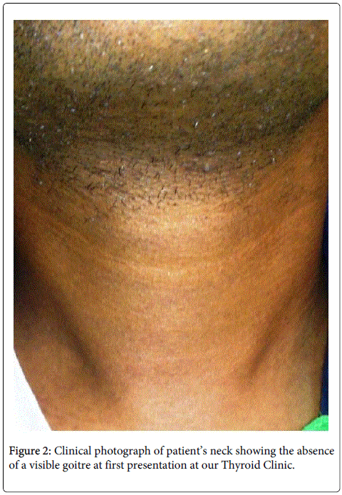 Natural Way Of Curing Hyperthyroidism Natural Way Of Curing Hyperthyroidism