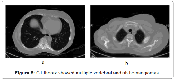 nuclear-medicine-vertebral-rib-hemangiomas