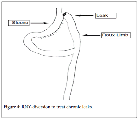 obesity-weight-loss-therapy-RNY-diversion
