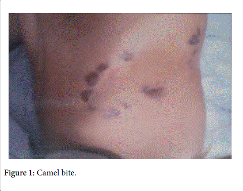 occupational-medicine-health-affairs-Camel-bite