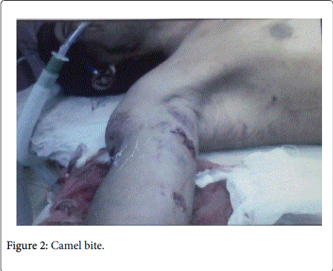 occupational-medicine-health-affairs-Camel-bite