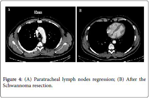 occupational-medicine-health-affairs-Paratracheal-Schwannoma-resection