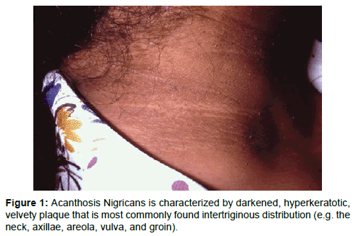 oncology-medicine-practice-Acanthosis-Nigricans