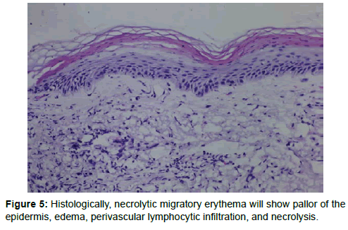 oncology-medicine-practice-Histologically-necrolytic-migratory