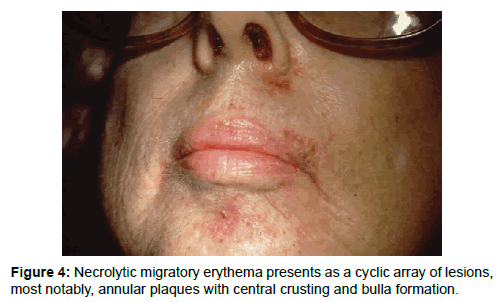 oncology-medicine-practice-Necrolytic-migratory-erythema
