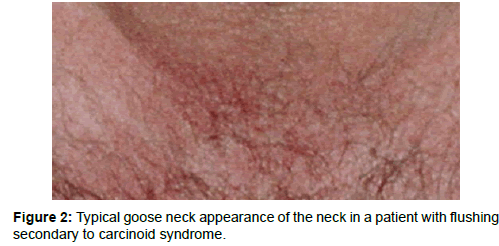 oncology-medicine-practice-Typical-goose-neck