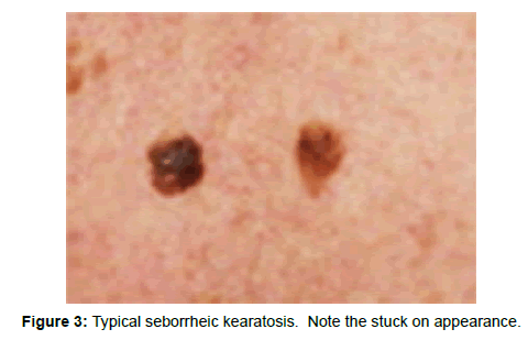 oncology-medicine-practice-Typical-seborrheic-kearatosis