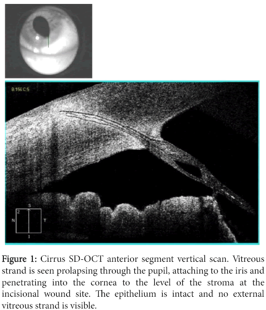 optometry-Cirrus-SD-OCT-anterior
