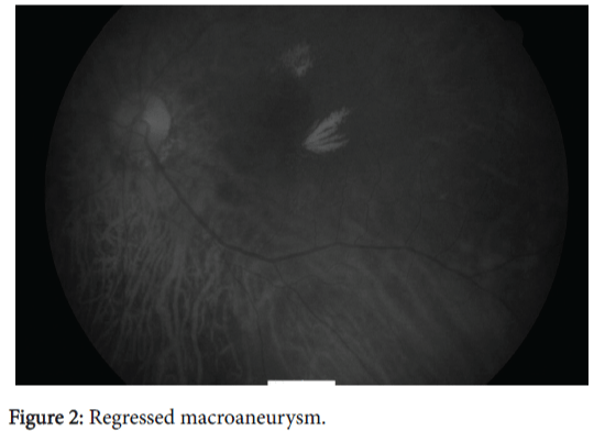 optometry-Regressed-macroaneurysm