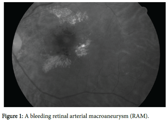 optometry-bleeding-retinal