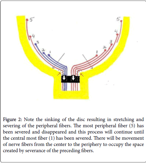 optometry-sinking-stretching-severing