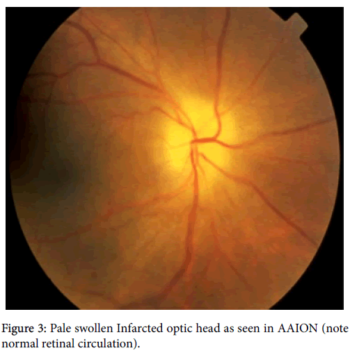 optometry-swollen-Infarcted-optic