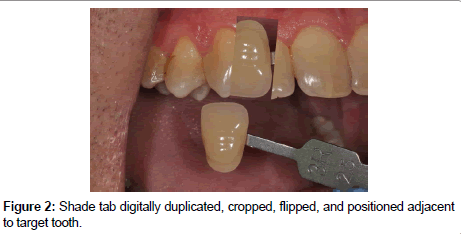 shade analysis by digitally flipping shade tabs omics international