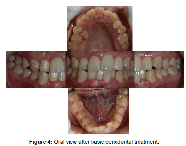 oral-hygiene-and-health-periodontal-treatment