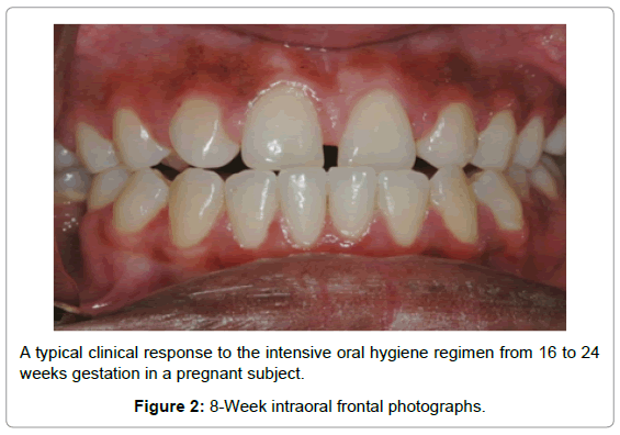 oral-hygiene-health-8-Week-intraoral-frontal