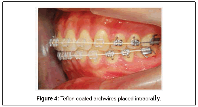 All About Orthodontic Arch Wires - ArchWired