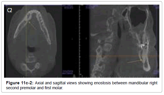 oral-hygiene-health-axial-sagittal-enostosis